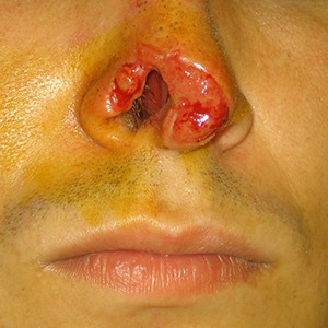 morsure au nez Morsure au nez