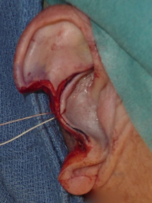 perte-de-substance-oreille Morsure au nez