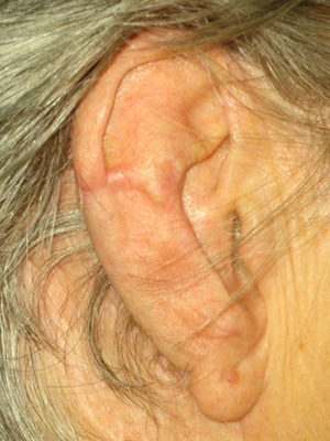 reconstruction-oreille Réparation du nez