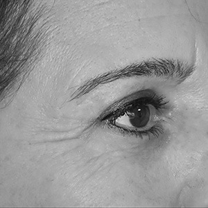 Paupières-supérieures-et-poches-sous-les-yeux-après-intervention Paupières supérieures et poches sous les yeux après intervention