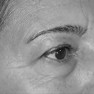 Paupières-supérieures-et-poches-sous-les-yeux-avant-intervention Paupières supérieures et poches sous les yeux avant intervention