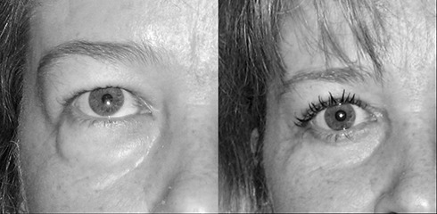 blépharoplastie des 4 paupières blépharoplastie des 4 paupières