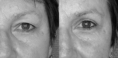 blépharoplastie supérieure