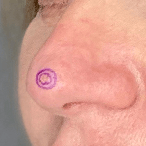 carcinome basocellulaire du nez Carcinome basocellulaire du nez