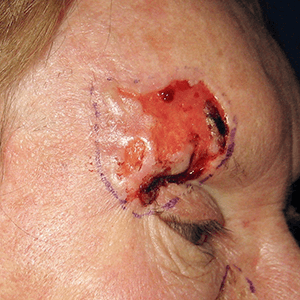 carcinome basocellulaire sourcil et paupière carcinome basocellulaire sourcil et paupière