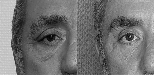 Chirurgie sourcil et paupières Chirurgie sourcil et paupières