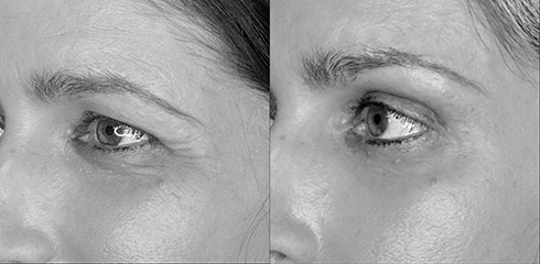lifting de la queue du sourcil lifting de la queue du sourcil