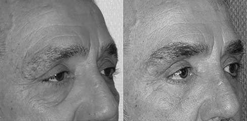 lifting des sourcils et des paupières