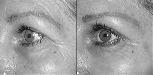 lifting du sourcil lifting du sourcil