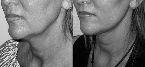lifting visage 01 Avant Après lifting du visage
