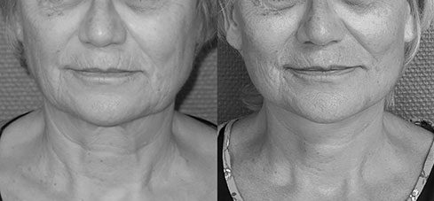 lifting visage 02 Avant Après lifting du visage