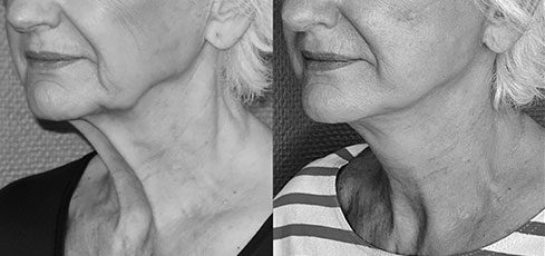 lifting-visage-03 Avant Après lifting du visage