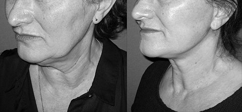 lifting-visage-04 Avant Après lifting du visage