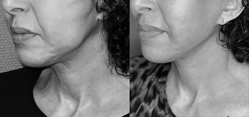 lifting-visage-05 Avant Après lifting du visage