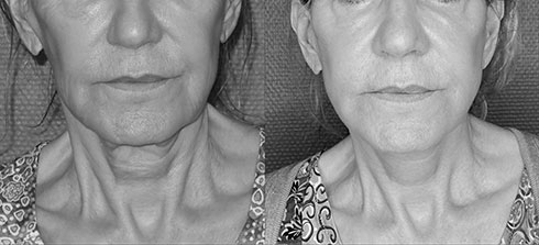 lifting-visage-06 Avant Après lifting du visage