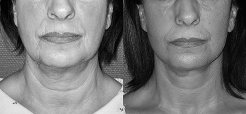 lifting-visage-07 Avant Après lifting du visage