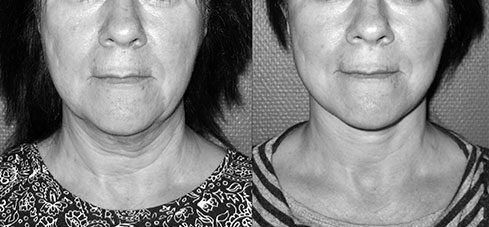 lifting-visage-08 Avant Après lifting du visage