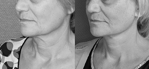 lifting-visage-09 Avant Après lifting du visage