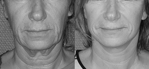 lifting visage 10 Avant Après lifting du visage