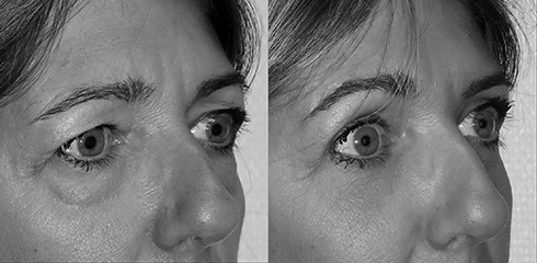 paupières + browlift paupières et browlift