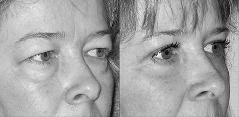 poches sous les yeux et paupières lourdes poches sous les yeux et paupières lourdes
