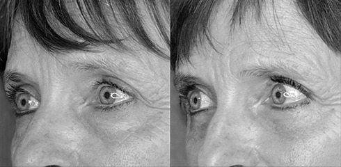 retension des paupières inférieures retension des paupières inférieures