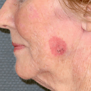 spinocellulaire superficiel étendu de la joue Carcinome spinocellulaire superficiel étendu de la joue