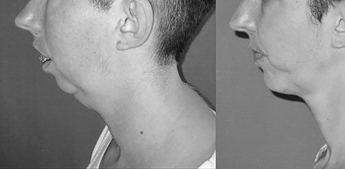 chirurgie des machoires Ostéotomie avant après