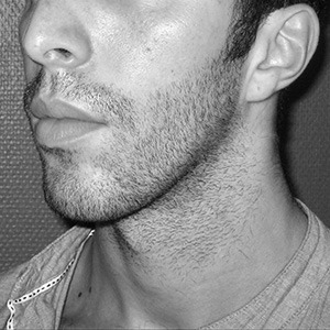 impaction maxillaire-1 Ostéotomie maxillaire