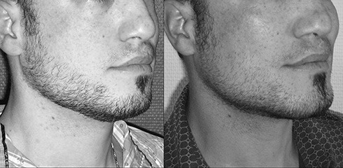 implants des pommettes et du menton Implants des pommettes et menton