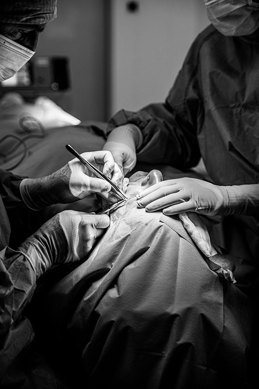opération des paupières ou blepharoplastie à lyon Intervention de chirurgie des paupières