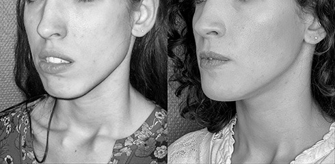 ostéotomie maxilaire avec génioplaste ostéotomie maxilaire