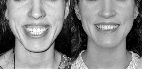 ostéotomie maxillaire avec génioplastie de face ostéotomie maxilaire