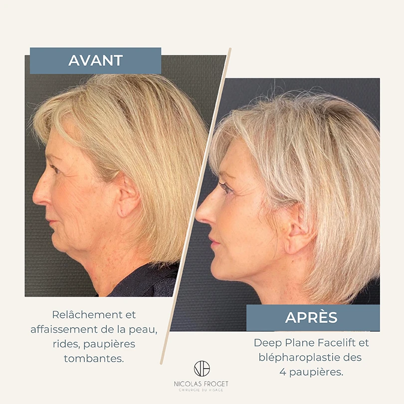 Avant Après deep plane facelift