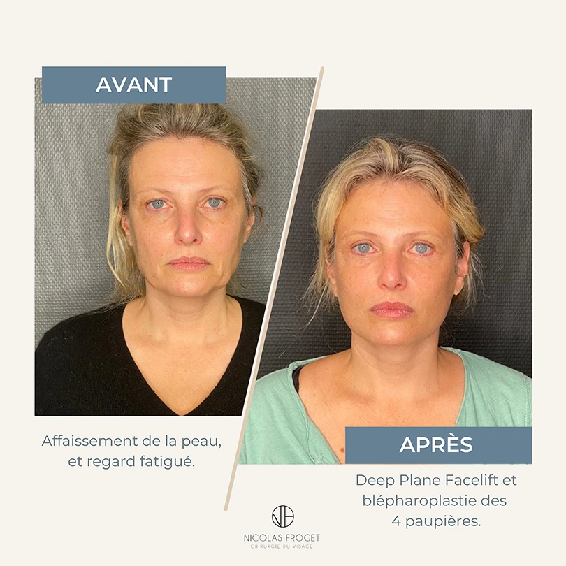 Avant Après deep plane facelift